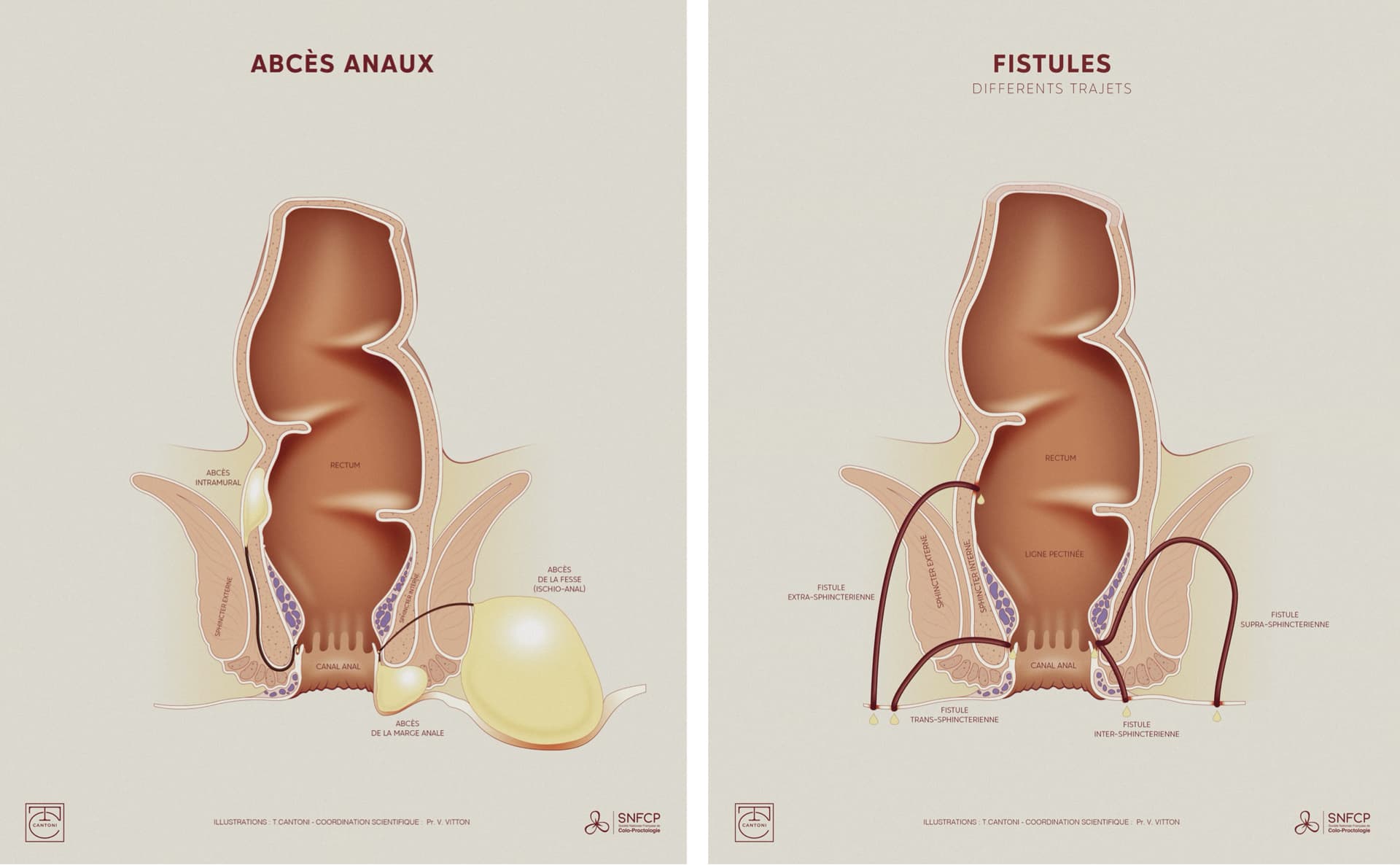 Schéma explicatif de chirurgie des abcès anaux et fistules
