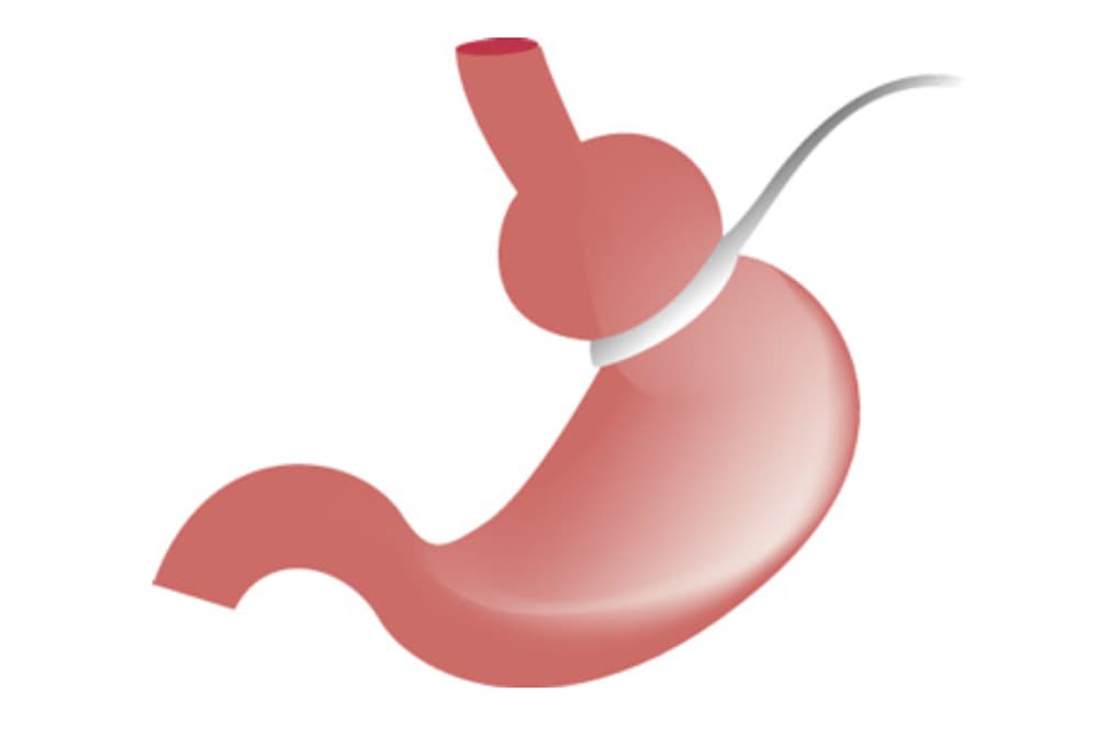 Schéma explicatif d'un anneau gastrique