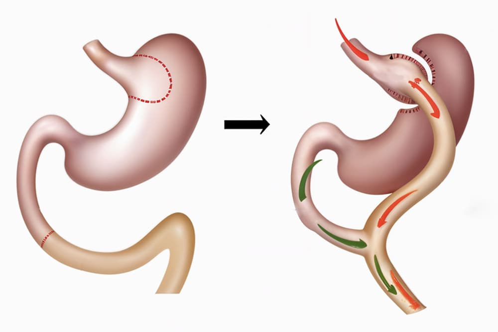 Schéma explicatif d'un By-pass