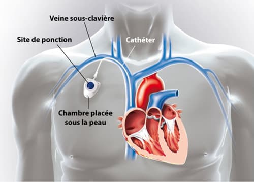 Schéma explicatif du fonctionnement d'une chambre implantable (Port-à-Cath)
