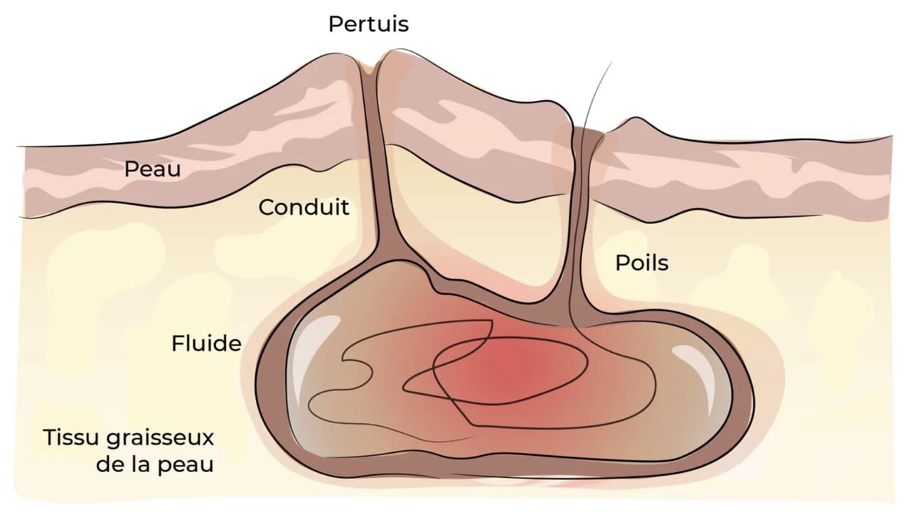 Schéma explicatif d'un sinus pilonidal